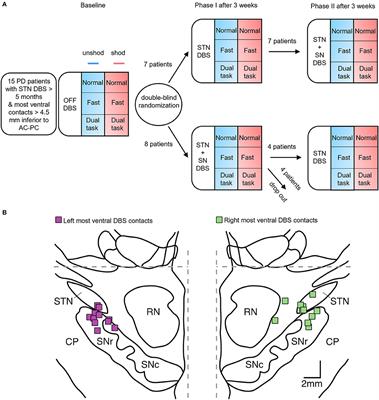 Comparison of Shod and Unshod Gait in Patients With Parkinson's Disease With Subthalamic and Nigral Stimulation